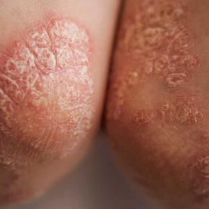 Image-EBX-Derma-05 (1)
